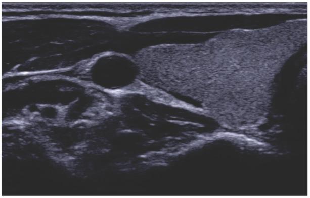 EU-TIRADS 1, normal parenchyma (cross-section of the right lobe)