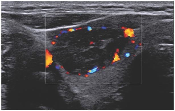 EU-TIRADS 4, solid hypoechogenic lesion. CD imaging shows marginal and central vascularisation