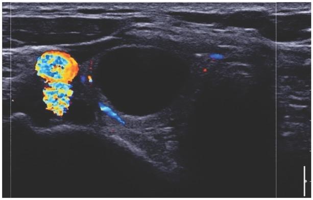 EU-TIRADS 2, simple cyst