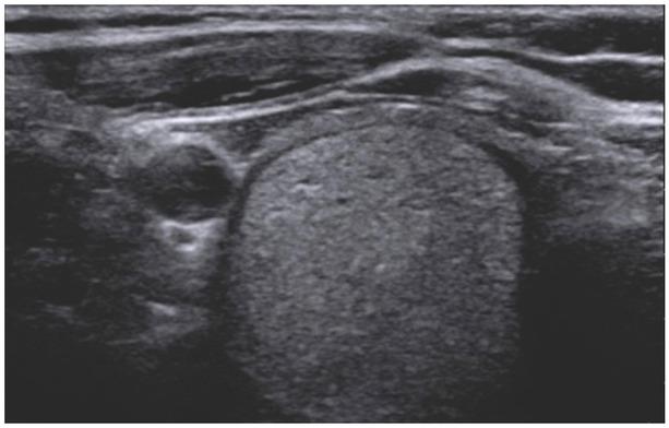 EU-TIRADS 3, solid isoechogenic lesion with hypoechogenic halo
