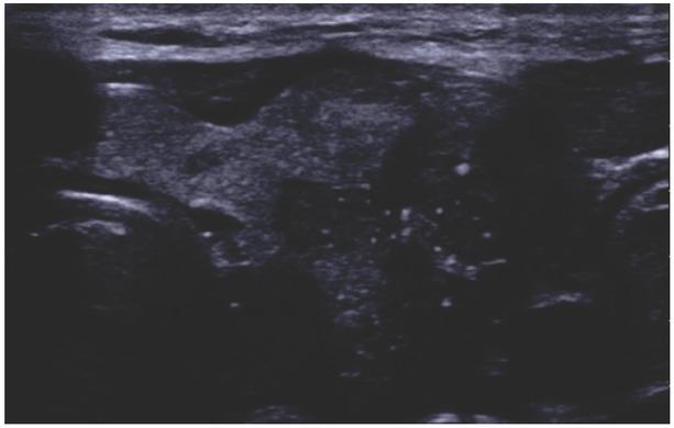 EU-TIRADS 5, solid hypoechogenic lesion with bright echoes (microcalcifications), uneven margins, irregular in shape