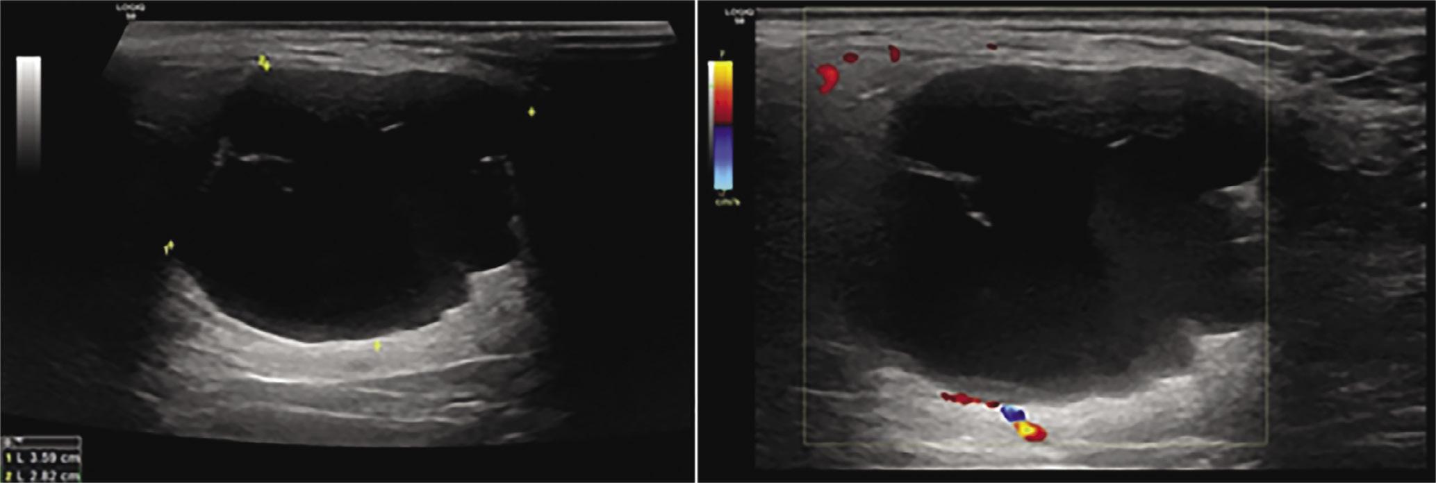 1st cleft cyst: in the inferior pole of the parotid gland one can observe a cystic-like lesion of multilobular borders, septa that are of low vascularity on color Doppler, and thick content, attached to the lateral borders