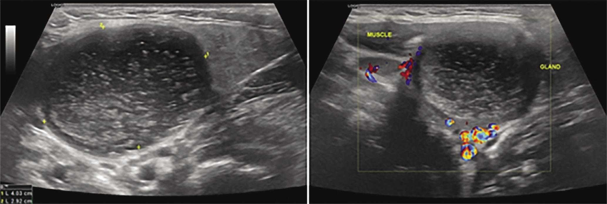 2nd cleft cyst: located in the submandibular region with thick mucous content of high echogenicity and without increased vascularity on color Doppler