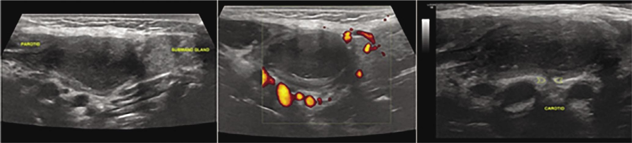 2nd cleft cyst: typical location of the lesion with anterior displacement of the submandibular gland, posterior displacement of the parotid gland, and inner pressure on the large vessels of the area. The presence of a small stem connecting the lesion to the carotid space is pathognomonic of the lesion