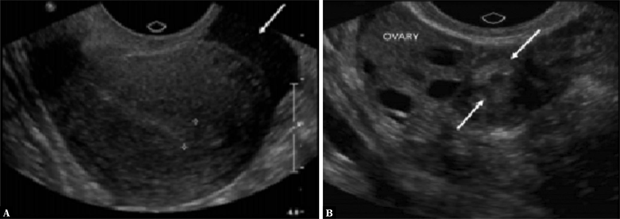 True ectopic pregnancy that was not ruptured, diagnosed in a patient with right adnexal pain. A. Transvaginal ultrasonography reveals a retroflexed uterus surrounded with minimally complicated pelvic fluid (arrow) and a thin endometrium (calipers(26)). B. An echogenic ring (arrows) next to the right ovary, the TEP (this shows the so-called sliding sign separate from the ovary)(27)