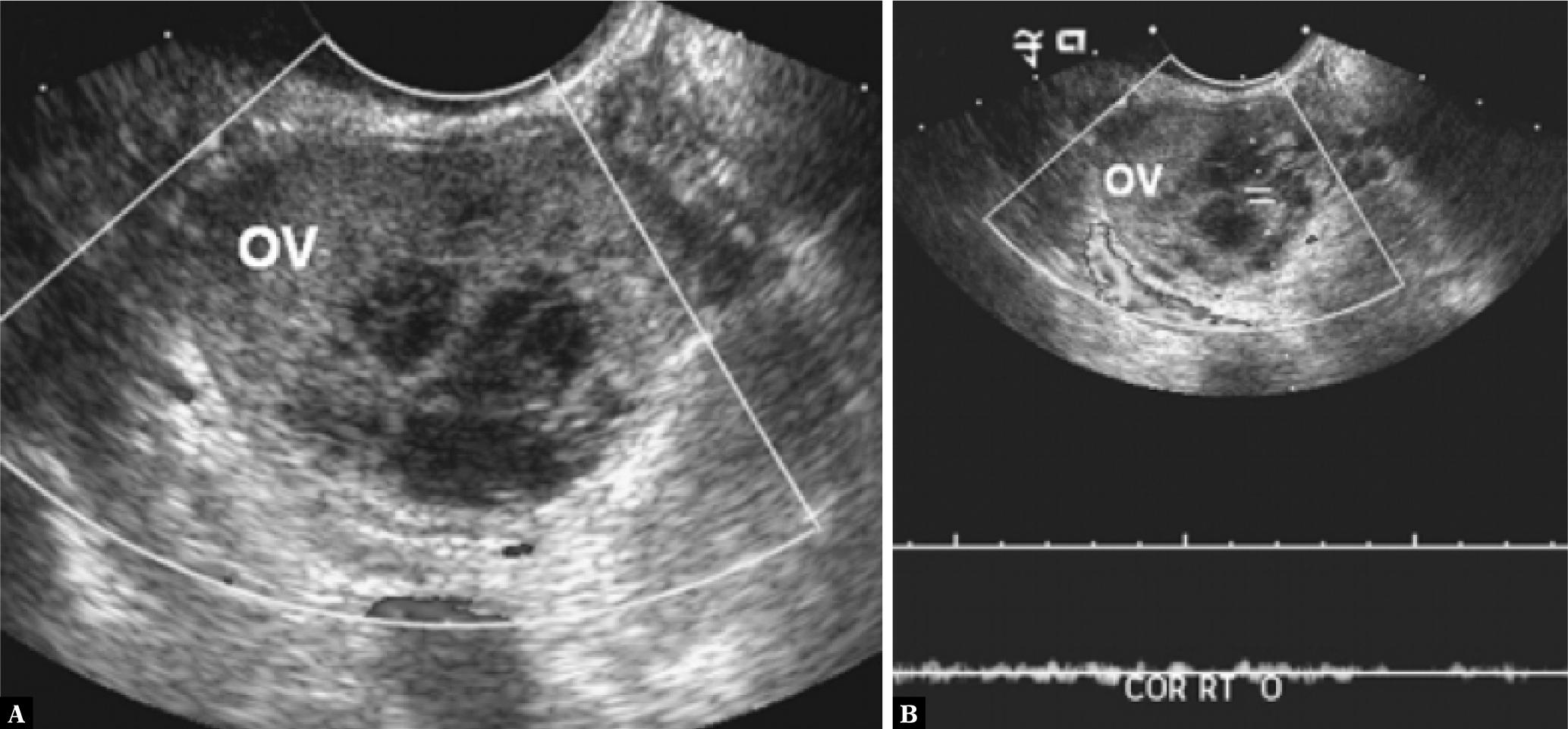 Torsion of the ovaries. Due to ovarian torsion, coronary transvaginal ultrasonography indicates an enlarged ovary with a hemorrhagic cyst and (A) no color flow and (B) no flow on duplex Doppler(34)
