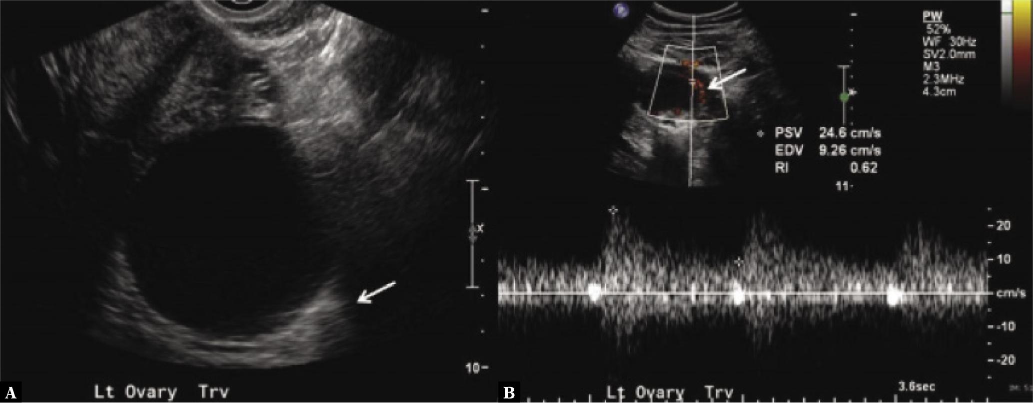 Ovarian cyst, simple/follicular. APP is brought in by a 31-year-old lady. A. A 6.0-cm anechoic cyst with a thin wall and posterior acoustic enhancement is revealed by TVS (arrow). B. Internal vascularity is not found on a pulsed Doppler examination. Normal low-velocity, low-resistance waveforms can be identified in the squeezed and thin margin of ovarian tissue (arrow). A one-year follow-up US examination was advised due to its significance(42)