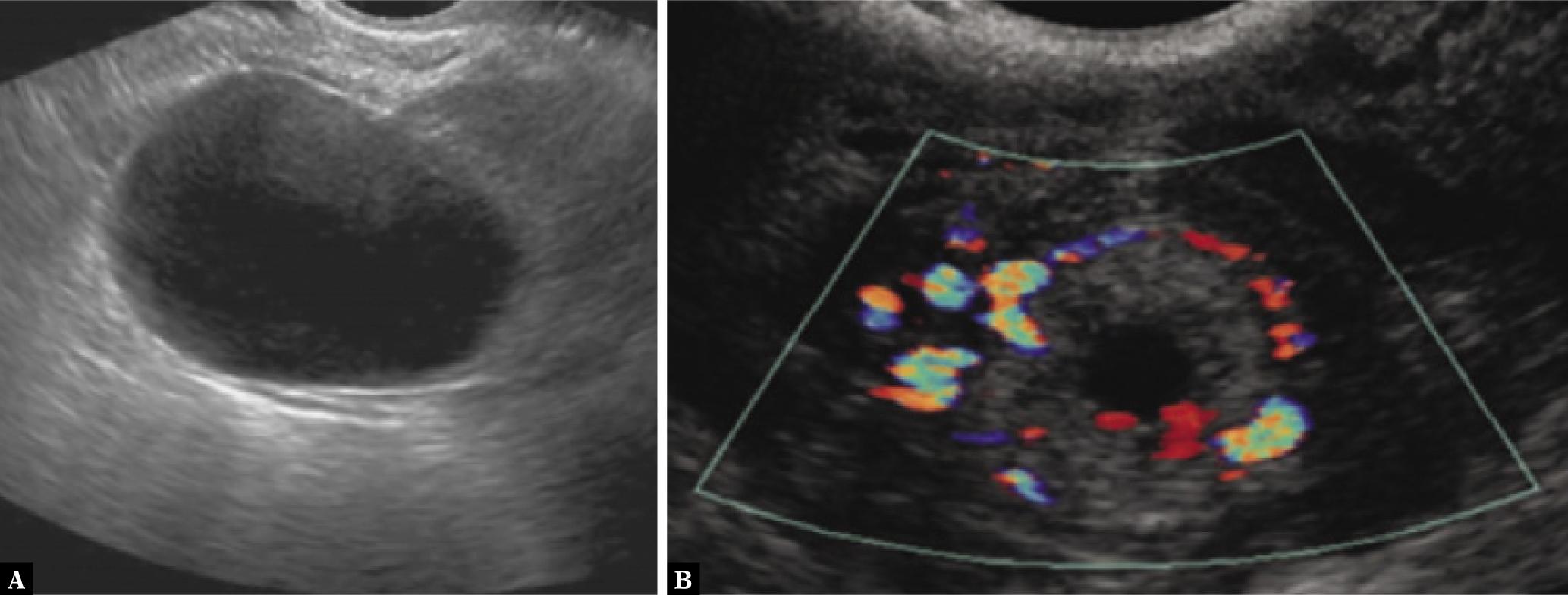 A simple ovarian cyst on the left side. A transverse transvaginal US image (A) shows a well-defined anechoic and hypoattenuating adnexal fluid accumulation. B. The corpus luteum is a Latin term that means “corpus of the luteum”. Color Doppler US shows the thick walls and improved peripheral vascularity of a newly established corpus luteum(18)