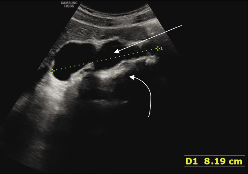 B-mode sagittal section of enlarged cisterna chyli (straight arrow), situated on the anterior surface of vertebral bodies (curved arrow)