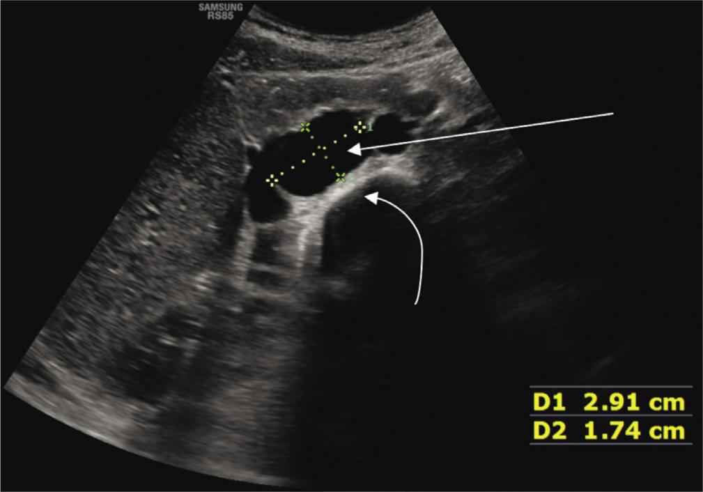 B-mode transverse section of enlarged cisterna chyli (straight arrow), situated on the anterior surface of vertebral bodies (curved arrow)