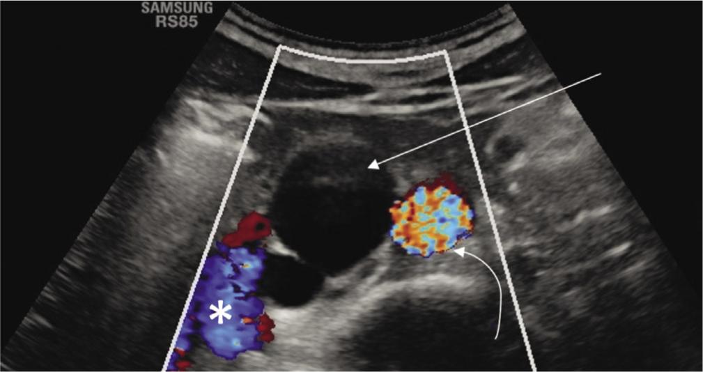 Color Doppler image shows no signal in cisterna chyli (straight arrow), located between the abdominal aorta (curved arrow) and inferior vena cava (asterisk)