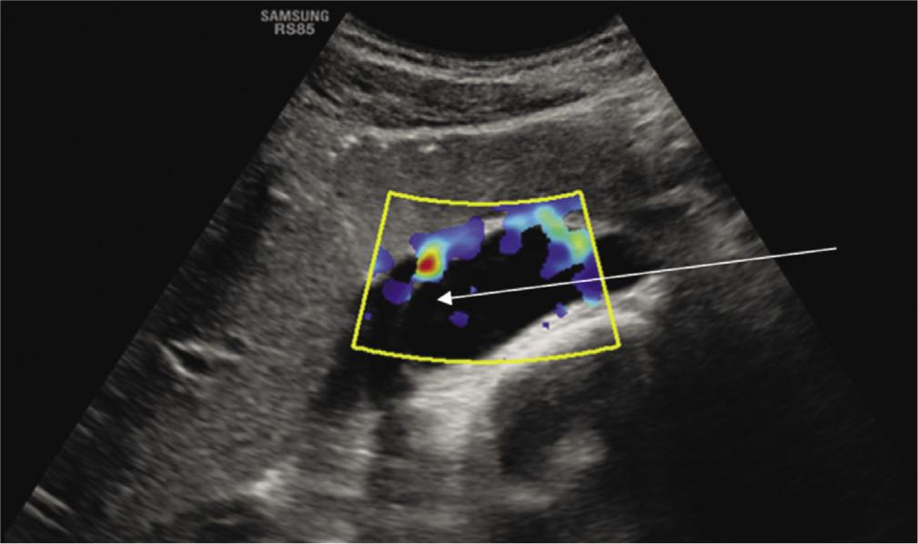 Cisterna chyli (straight arrow) exhibits no signal in shear-wave elastography
