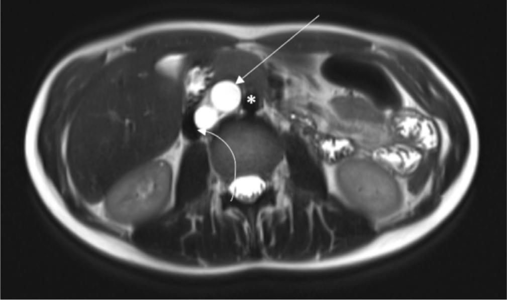 Axial HASTE sequence shows a lobulated cystic lesion (arrow) between the aorta (asterisk) and inferior vena cava (curved arrow) with partial compression of the vein