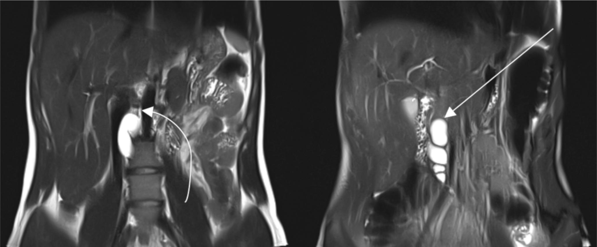 Coronal HASTE sequence images at two different levels show a cystic lobulated lesion (arrow) in continuity with thoracic duct (curved arrow)