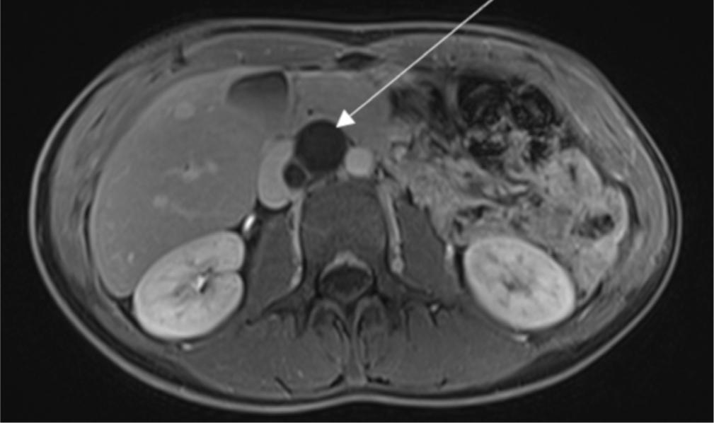 Axial T1-weighted sequence after intravenous administration of gadolinium-based contrast agent shows no enhancement of the cystic lesion (arrow)