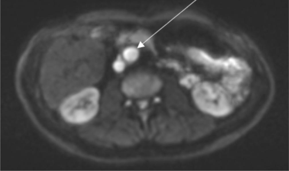 Axial DWI shows restricted diffusion of the lesion (arrow)