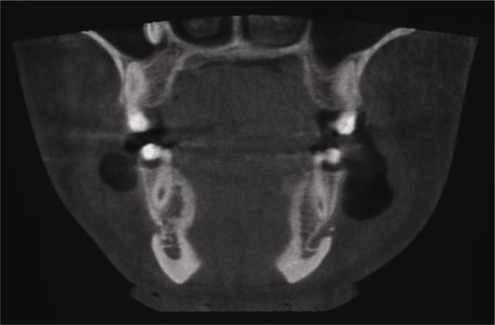 Frontal CBCT slice of the mandible with a barely visible exophytic lesion at the mandibular border