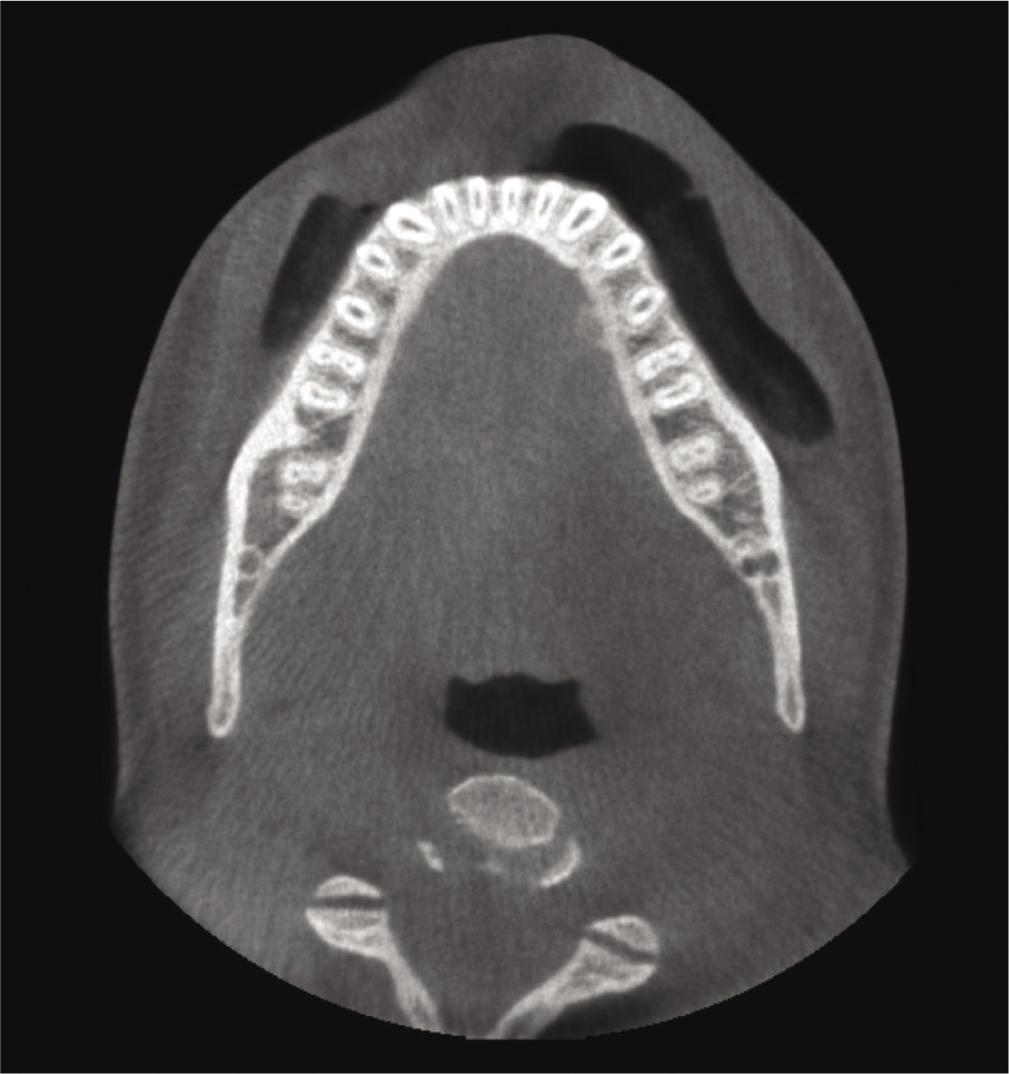 Axial slice of the lesion without a clearly visible lesion present