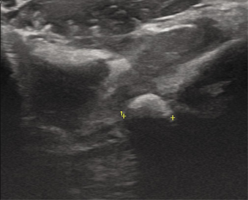US of the lesion, with the exophytic growth from the bone visible
