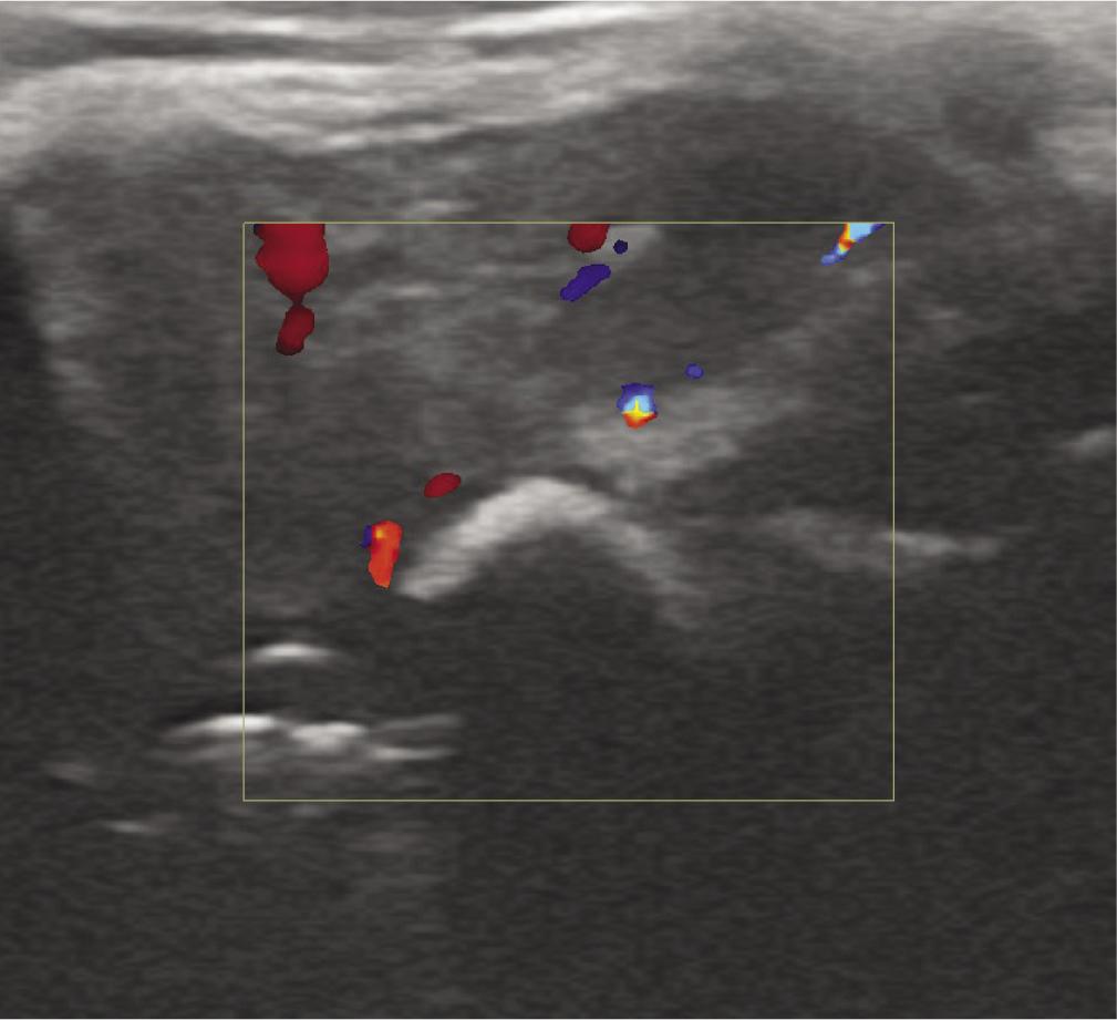 Color Doppler of the lesion, with no vasculature observed