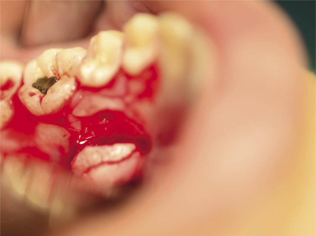 Excision of the lesion intraorally