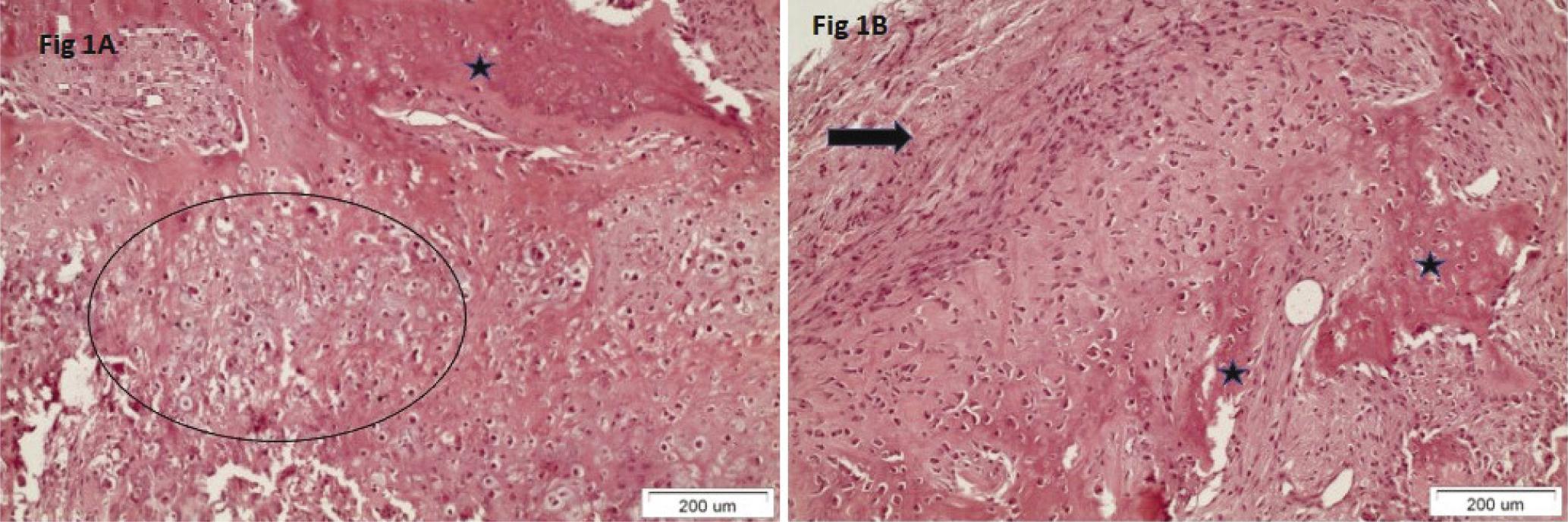 Histopathology of the lesion where chondroid cells in regions turned to osteoid with mature osseous content. The base of the lesion is fibrous, with low cellularity and no particular cellular atypia or mitoses