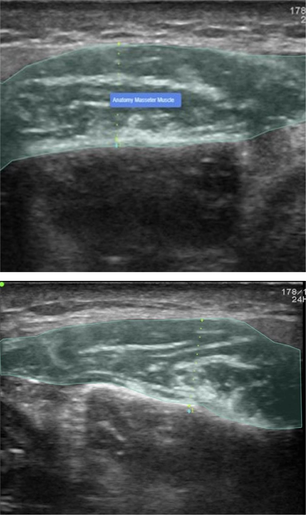 The images show the Masseter Muscle Measurements performed using AI Models (CranioCatch, Eskisehir- Turkey)