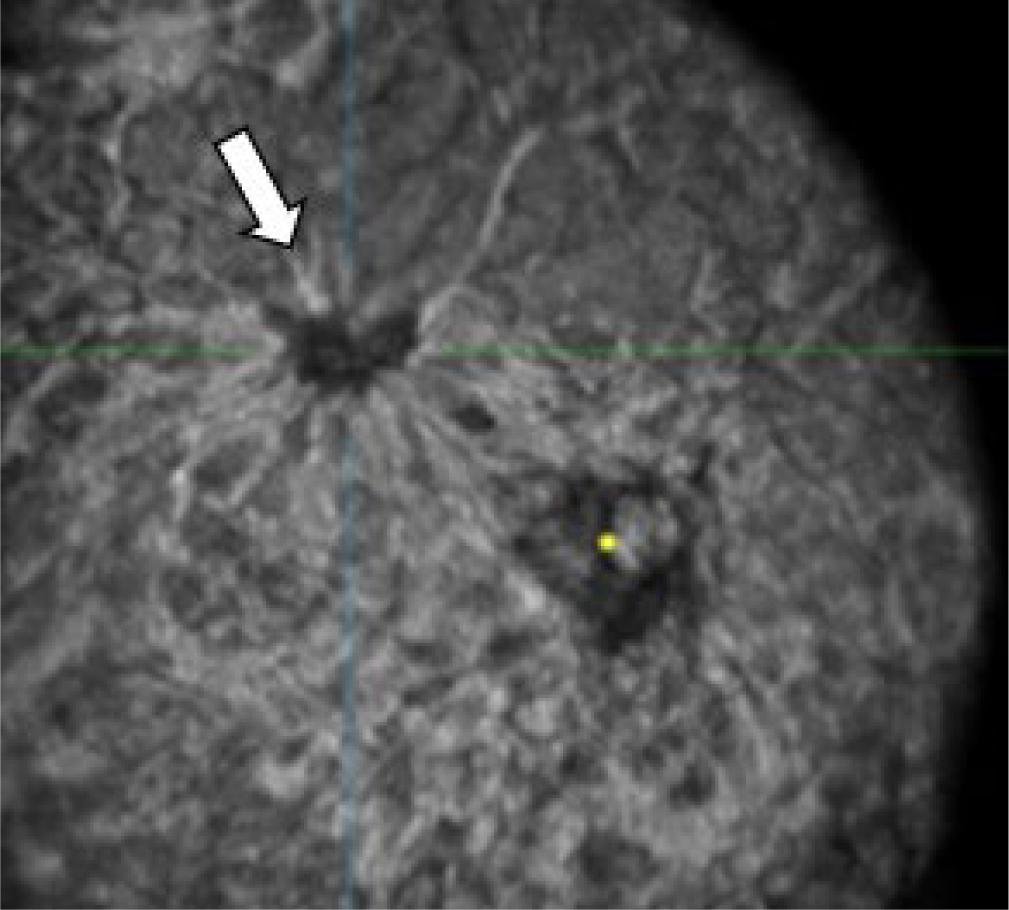 Retraction sign. Coronal lateral ABUS image of the right breast in a 64-year-old woman shows a strong retraction pattern (white arrow) of the tumor at the upper lateral quadrant. The nipple is marked by the yellow dot