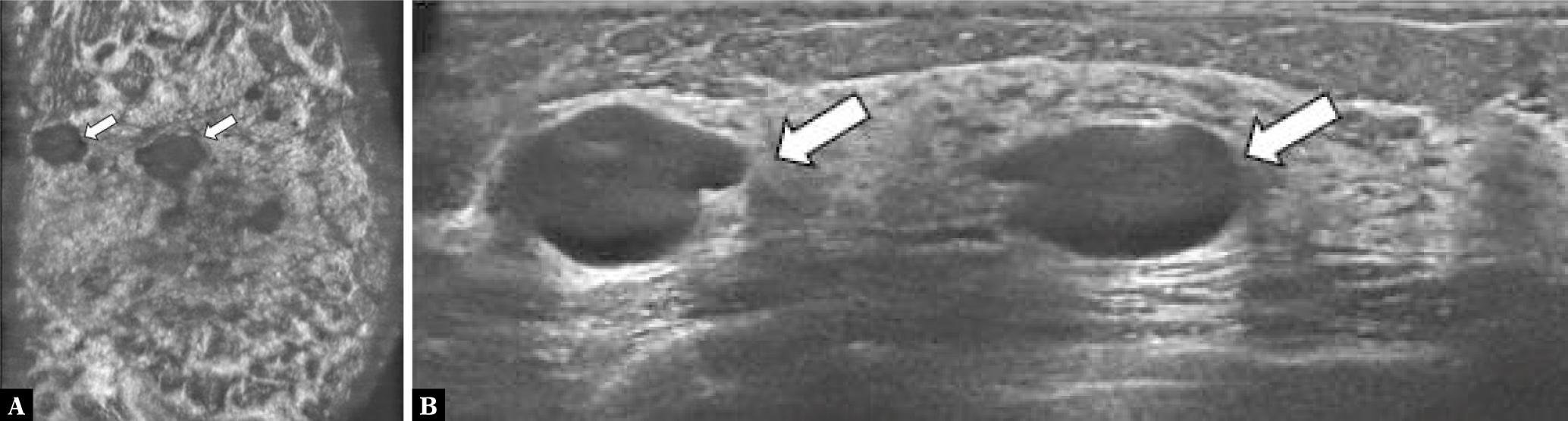 Multiple cysts in the upper lateral quadrant of the right breast. Coronal anteroposterior (A) and axial (B) ABUS images in a 38-year-old woman show multiple cysts (white arrows) with an overall acoustic enhancement and subtle intralesional reflections. There are no solid components, and the long axis is parallel to the skin on the axial image