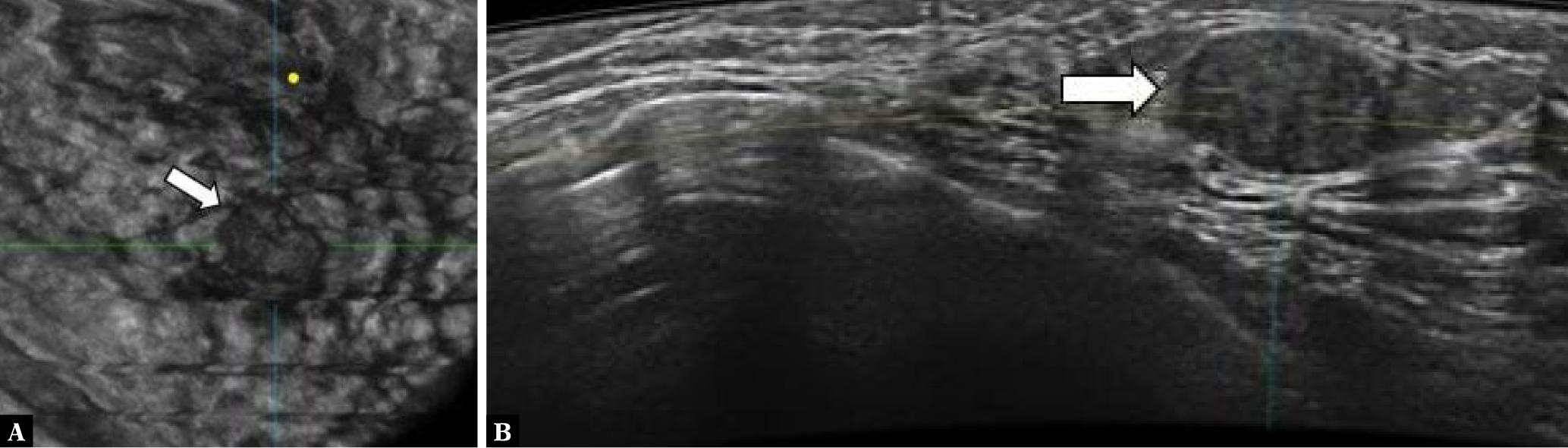 Fibroadenoma. Coronal lateral (A) and axial (B) ABUS images of the right breast in a 32-year-old woman with heterogeneously dense breasts and negative screening mammography. ABUS images show a circumscribed hypoechoic lesion (white arrow) within a fine peripheral capsule. The lesion has no posterior acoustic features or the sign of retraction on the coronal plane