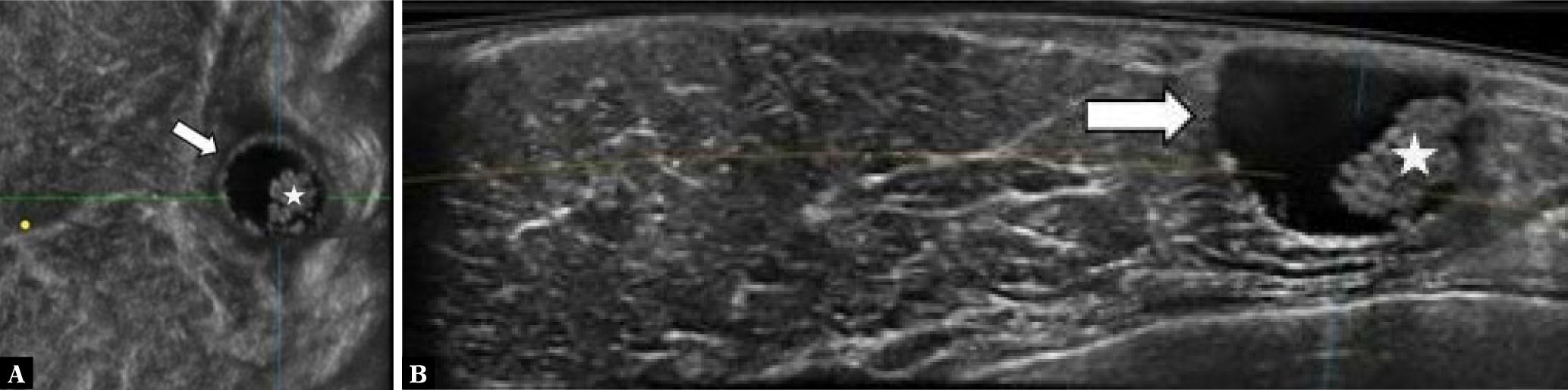 Fat necrosis in a chronic stage. Lateral coronal reconstruction (A) and axial plane (B) ABUS images in a 63-year-old woman in the upper outer quadrant of the left breast shows a well-defined lesion with partial cystic components with debris (white arrow and white asterisk) surrounded by edematous fat