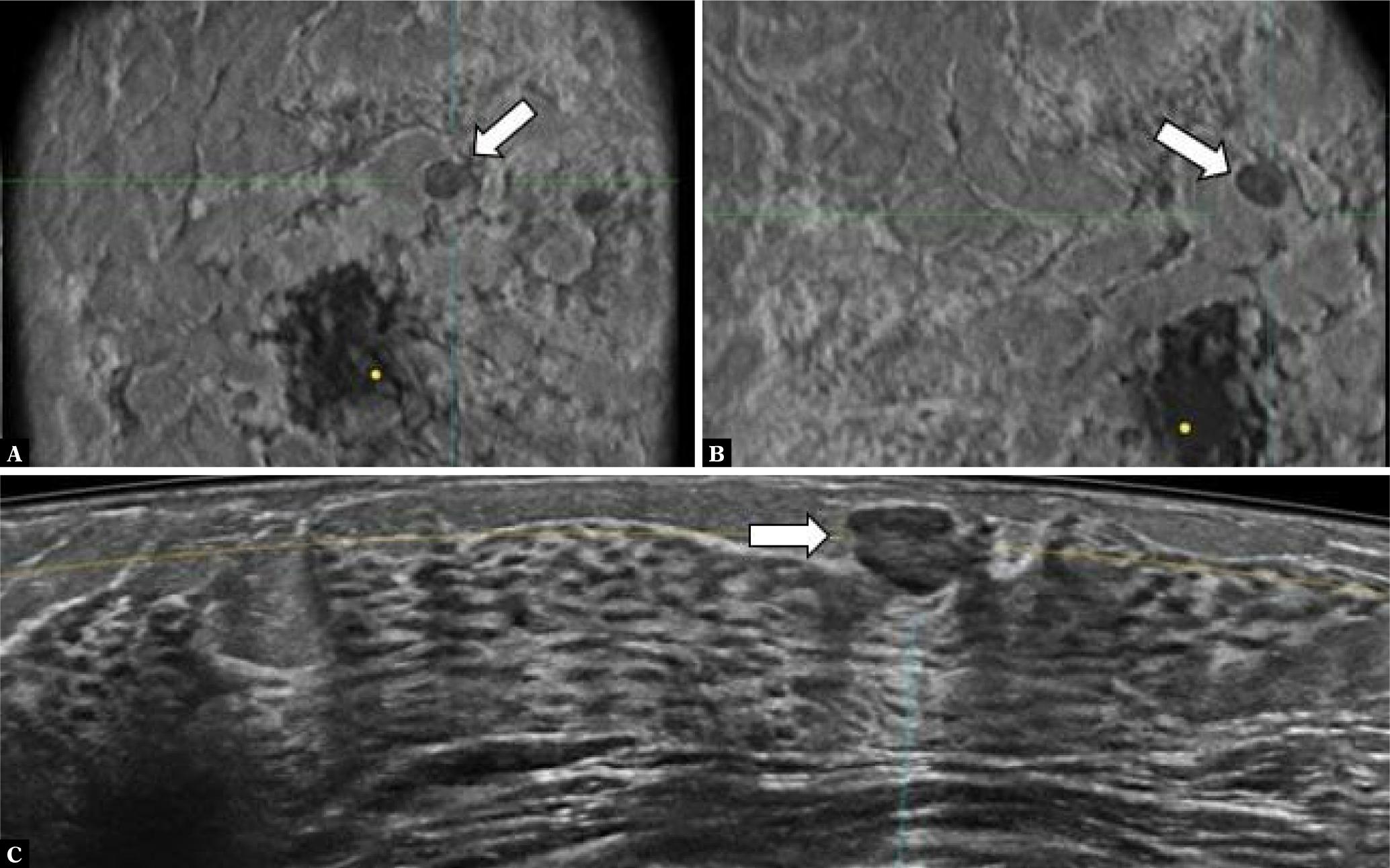 Papilloma. Coronal anteroposterior (A), coronal lateral (B) and axial (C) ABUS images of the right breast in a 38-year-old asymptomatic woman at a high risk of developing breast cancer. Notice an irregular hypoechoic lesion (white arrow) with a heterogeneous echo pattern and partial posterior acoustic enhancement (arrows). Histological core needle biopsy showed an intraductal papilloma without signs of invasive or in situ carcinoma or atypia