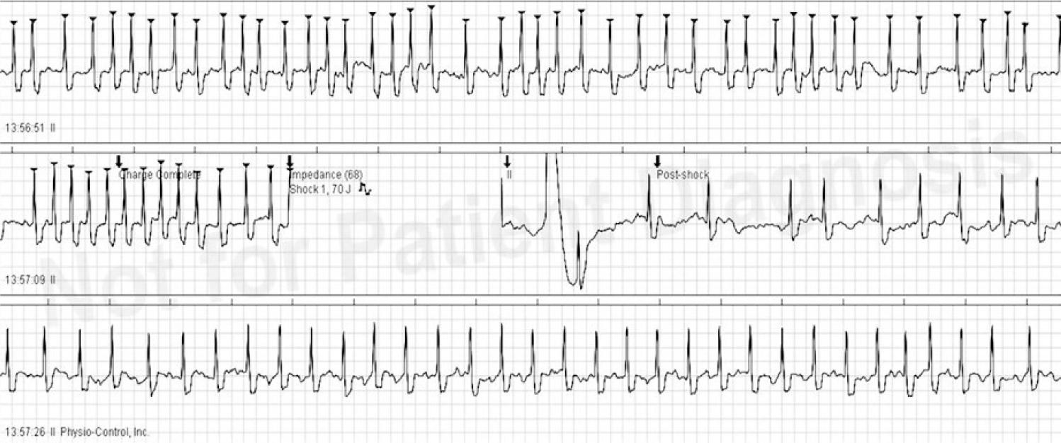 Successful electrical cardioversion of atrial fibrillation using biphasic shock with energy of 70J