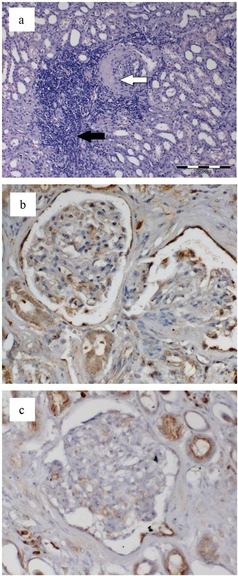 A histopathological assessment of the kidney of a dog without blood azotaemia, suffering from cardiac insufficiency due to severe stage Da mitral endocardiosis according to the ACVIM classification (9)
a – H-E stained section. Interstitial, lymphocytic inflammatory infiltration (black arrow) and glomerular hyalinosis and atrophy (white arrow) are visible;
b – the immunohistochemical reaction in the kidney section of the same dog, using polyclonal rabbit anti-nephrin antibody (cat no. abx019258, Abexxa, UK, 1:200 dilution). A weak reaction indicates podocyte damage;
c – a weak immunohistochemical reaction indicating podocyte damage, using polyclonal rabbit anti-podocin antibody (cat no. abx019257, Abexxa, 1:400 dilution). The sections were washed with Dako Wash Buffer (10×) (product code S3006, Agilent, USA). The Peroxidase/DAB+ Rabbit/Mouse Dako Real EnVision Detection System was used to visualise the immunohistochemical reaction (product code K8006, Agilent). The microphotographs of the studied sections come from our own research and were subjected to computer-aided image analysis using cellSens software (Olympus Soft Imaging Solution GmbH, Germany) coupled with an optical Olympus BX53 microscope equipped with a ColorView IIIu digital camera (Olympus, Japan)