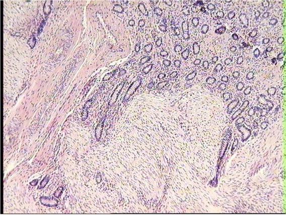 Proliferation of mucosal basal glands into the muscular layer in the uterus of dairy cow. HE, 10×