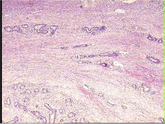 Foci of the endometrial pathological tissue disseminated in the muscular layer in the uterus of dairy cow. HE, 10×