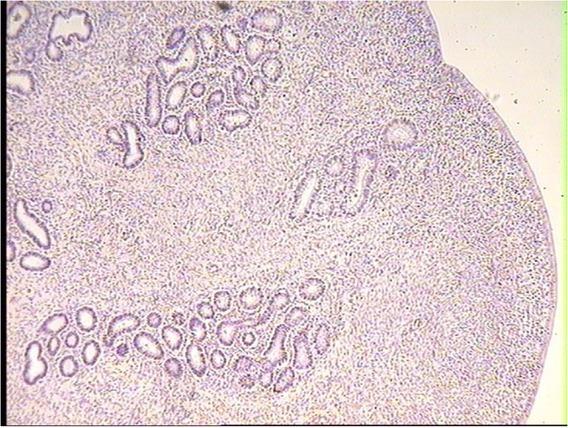 Interstitial fibrosis of the superficial, functional mucosa layer, accompanied by glands atrophy in the uterus of dairy cow. HE, 10×