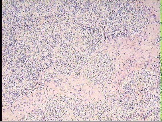 Focus of PEComa neoplastic tissue in the ovary of a dairy cow with an adenomyotic uterus. HE, 20×
