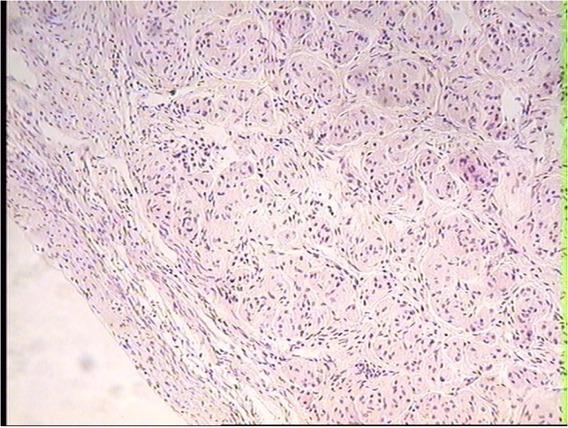 PEComa tissue overgrowth to the ovarian capsule in the ovary of a dairy cow with an adenomyotic uterus. HE, 20×