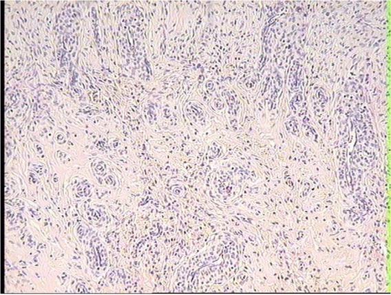 Neoplastic PEComa tissue infiltrating ovarian stroma in the ovary of a dairy cow with an adenomyotic uterus. HE, 10×