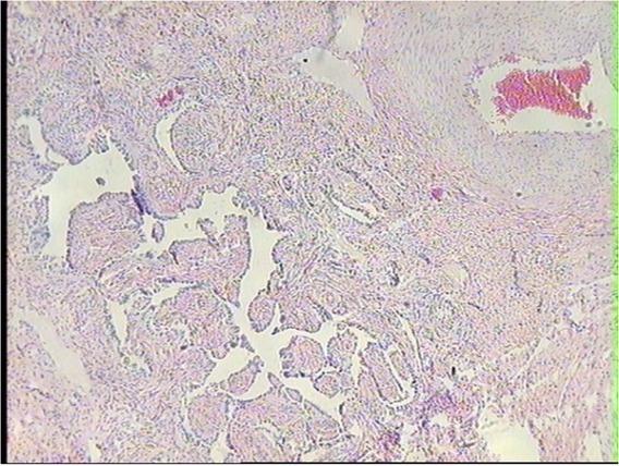 Adenoma of rete ovarii cells in the ovary of a dairy cow with an adenomyotic uterus. HE, 10×