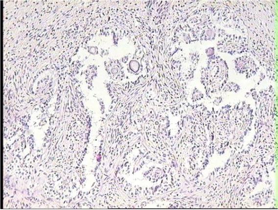 The minute foci of granulosa cell tumour associated with adenoma of rete ovarii cells the ovary of a dairy cow with an adenomyotic uterus. HE, 20×