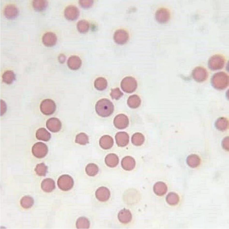 Representative cytological image of a bone marrow smear stained with the May–Grünwald–Giemsa method showing a Howell– Jolly body in erythrocyte in the HD group on day 28; 1,000×