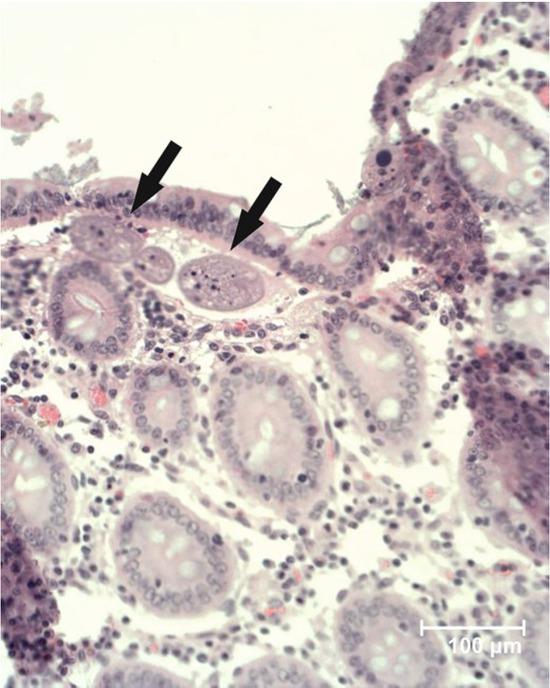Balantidium coli (arrows) invading colonic mucosa (haematoxylin and eosin, × 200)