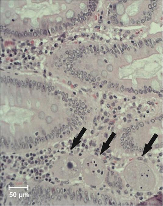 Balantidium coli (arrows) in colonic mucosa (haematoxylin and eosin, × 100)