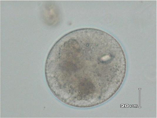 Balantidium coli cyst detected in faeces
