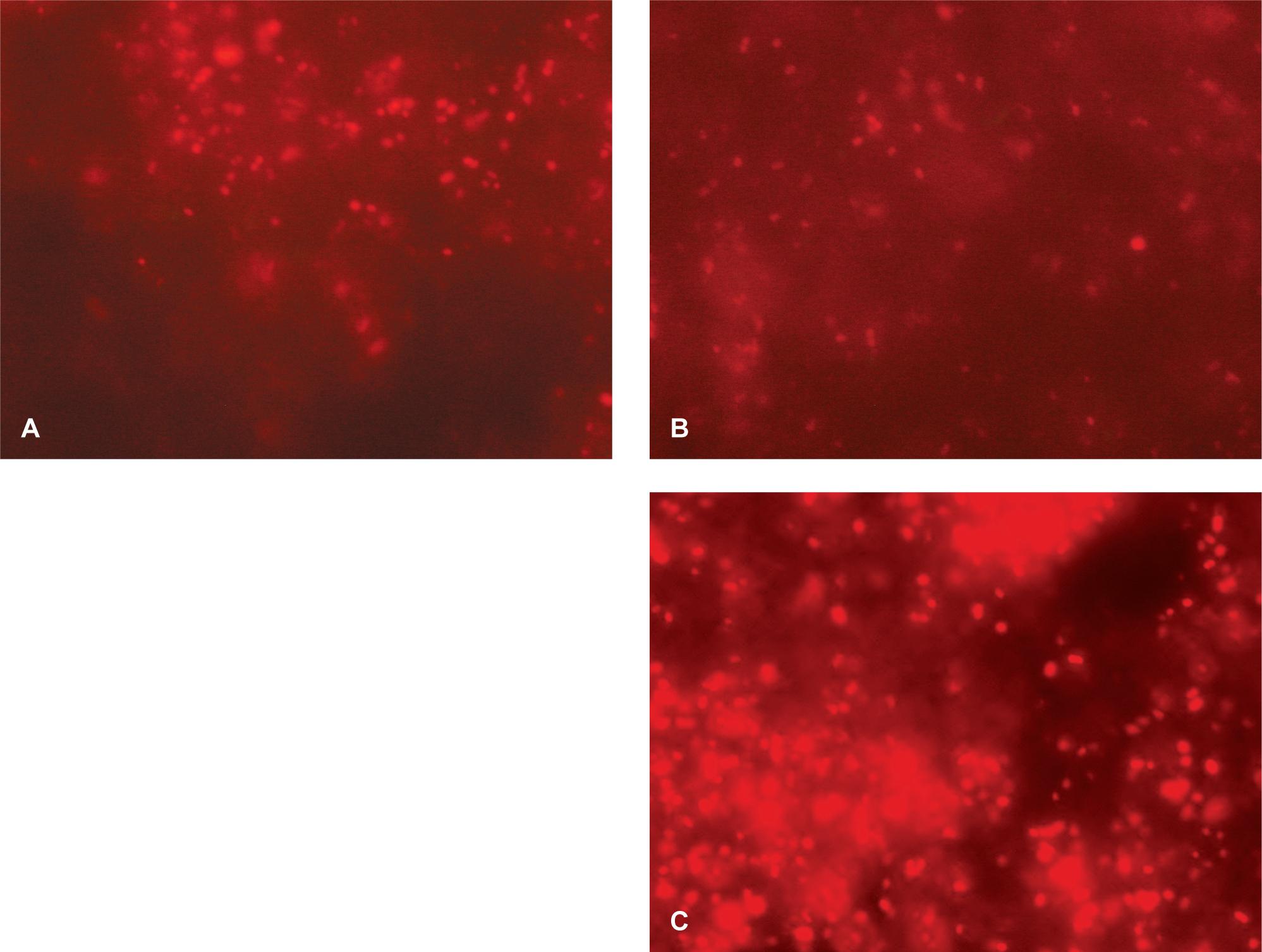Detection of Acinetobacter sp. in a blood culture specimen by FISH.Panels A, B, and C show the same specimen. (A) Shows red signal of Acinetobacter sp. cells, indicating hybridization with probe Aci-Cy3 (signal intensity 2+). (B) Indicates hybridization with probe ACA-Cy3 (signal intensity 1+). (C) Simultaneous hybridization with two probes Aci-Cy3 and ACA-Cy3 increased the fluorescent signal intensity of Acinetobacter sp. cells (signal intensity 3+) so that the detection of the bacterium was facilitated. Magnification, × 1000.