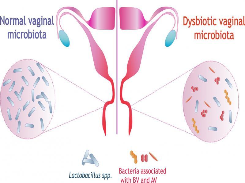 Normal vaginal microbiota and vaginal dysbiosis.