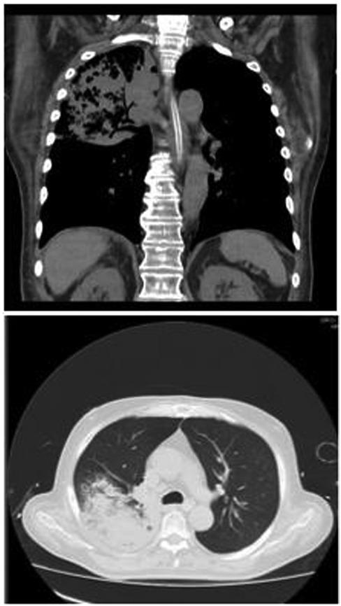 High-resolution computed tomography at the second day of hospital stay.