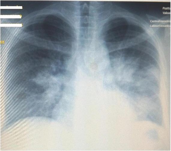 Initial chest X-ray: multiple diffuse opacities distributed in the half inferior part of both lung areas, suggestive of bilateral bronchopneumonia.